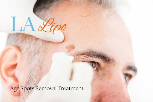 What Are the Most Effective Treatments for Age Spots Melton Mowbray?