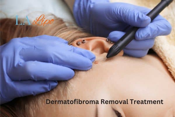 Dermatofibroma Removal Treatment Melton Mowbray