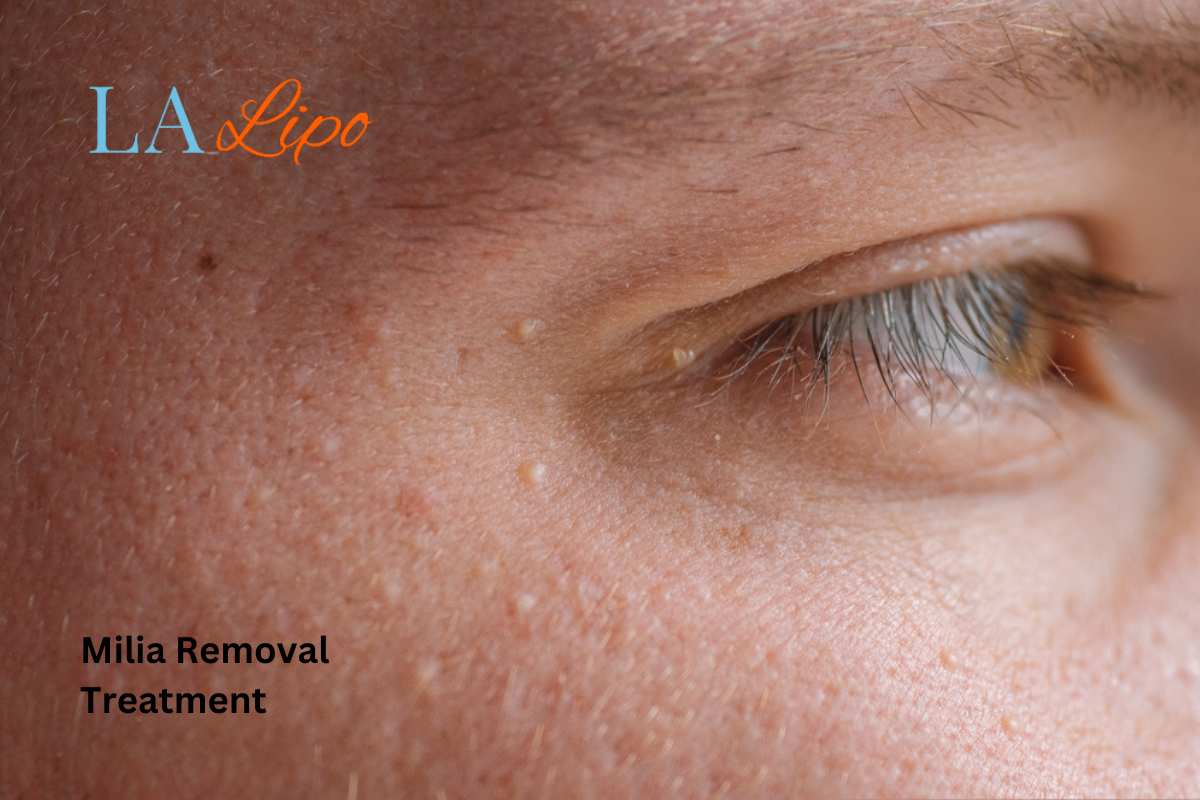 Cryopen Milia Removal: Is It the Easiest and Safest Option Melton Mowbray?