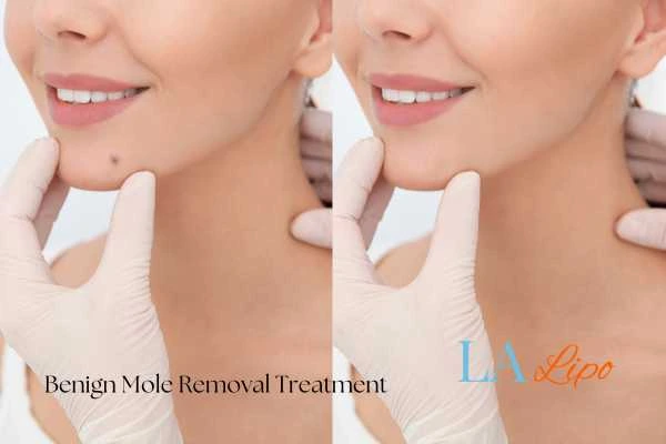 woman's before and after mole removal Melton Mowbray results