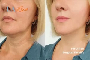 hi-fu for wrinkles Melton Mowbray before and after results