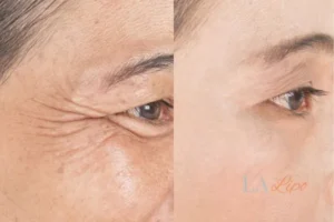 Before and after results of woman - HI-fu wrinkles reduction treatment Melton Mowbray