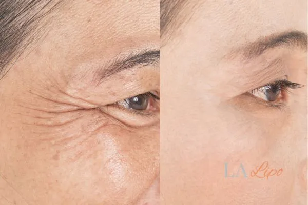 Before and after results of woman - HI-fu wrinkles reduction treatment Melton Mowbray