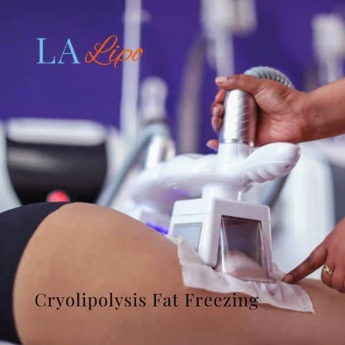 fat freezing - Cryolipolysis Melton Mowbray