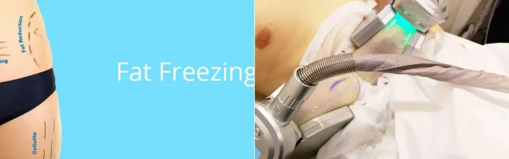 Fat freezing Melton Mowbray on multiple areas of the body