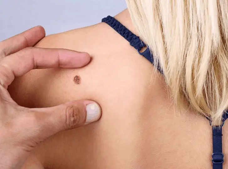 woman having mole removal Melton Mowbray consultation before treatment.