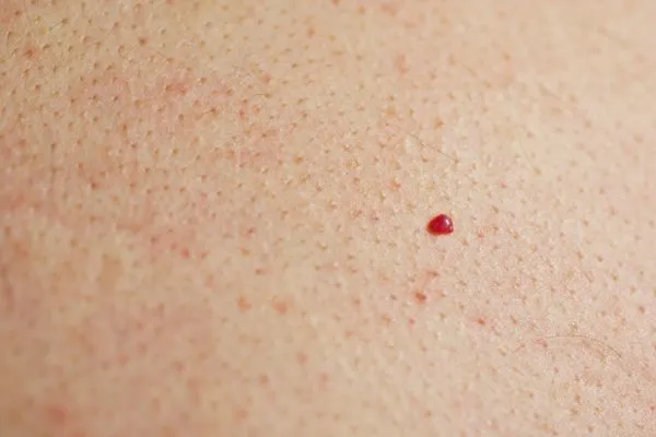 close up of a cherry angioma Melton Mowbray