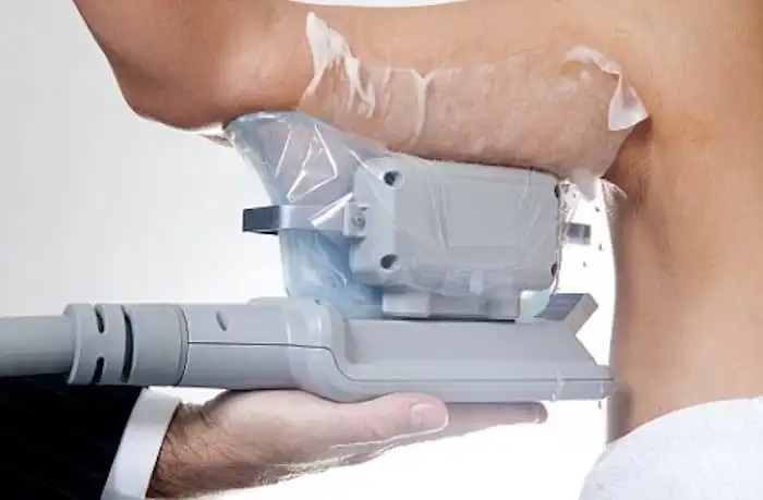 Picture of fat freezing Melton Mowbray on the upper arms.