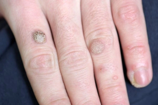 photo of warts on person hand - see wart removal Melton Mowbray from LA LIPO