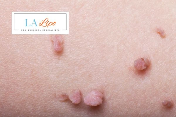 Does cryopen skin tag removal Melton Mowbray hurt? Find out now call our team today!