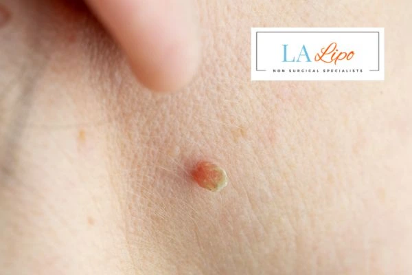 Book skin tag removal Melton Mowbray today speak to our team now!