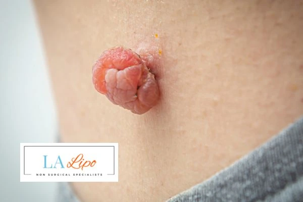 Interested in skin tag removal Melton Mowbray? Concerned about the pain? Find out more today!