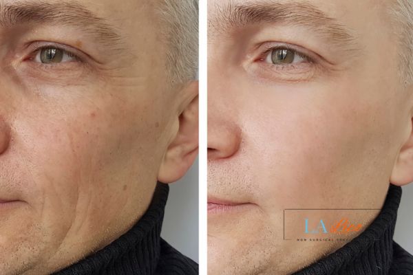 See the amazing results of Morpheus8 Treatment Melton Mowbray!