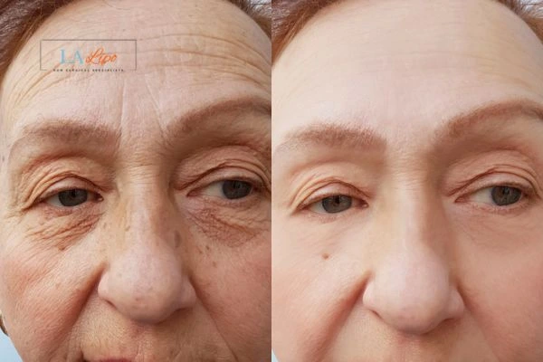 The powerful benefits of Morpheus8 Treatment Melton Mowbray - Call Our team today!