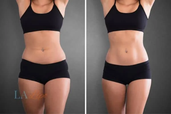 before and after results of non-surgical treatment to help a woman's body image and mental health Melton Mowbray