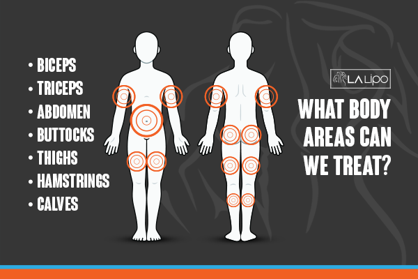 Diagram to show areas you can have LA-EMS Body Sculpting Treatment Melton Mowbray