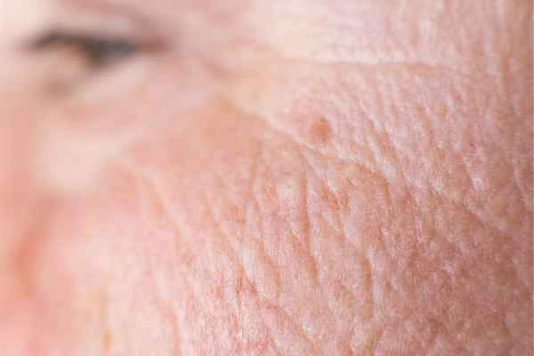 close up picture of a woman's face showing an age spot Melton Mowbray