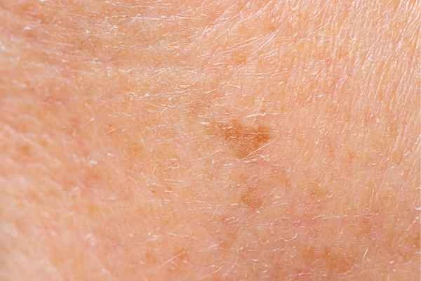 close up picture of age spots Melton Mowbray