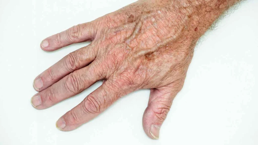 Male hand showing age spot Melton Mowbray