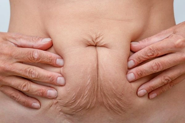 Image of a woman's stomach with loose skin - example of skin tightening Melton Mowbray options