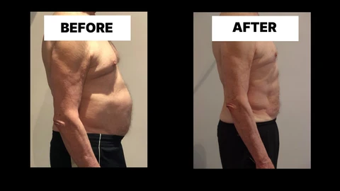 What Symptoms Can Diastasis Recti Cause in Men? Weak Core, Back Pain and Poor Posture Melton Mowbray